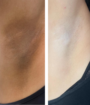 clareamento de axilas clinica enfase thais guimaraes saintclair