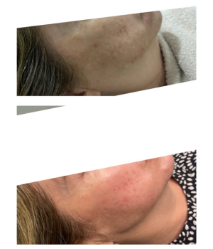 clareamento de melasma clinica efase thais guimaraes saintclair