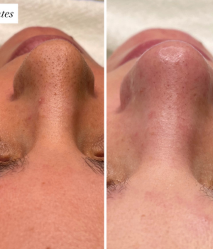 limpeza de pele clinica enfase thais guimaraes saintclair