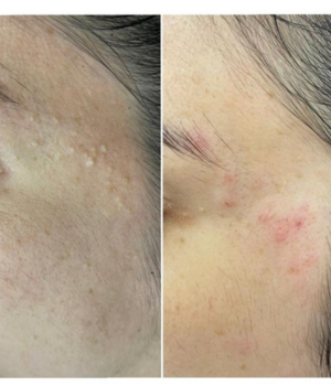 remoção de millium clinica enfase thais guimaraes saintclair