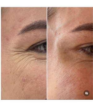 toxina botulinica olhos clinica enfase thais guimaraes saintclair