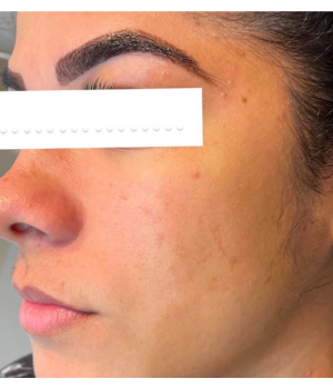 tratamento para acne clinica enfase thais guimaraes saintclair 1