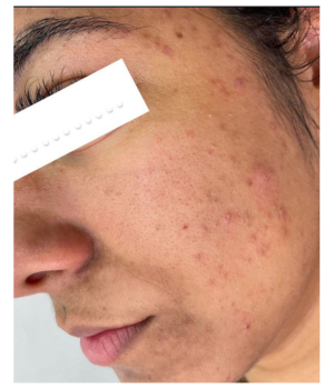 tratamento para acne clinica enfase thais guimaraes saintclair