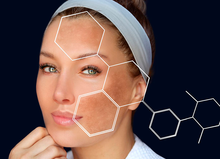 Melasma: O Que É, Por Que Aparece e Como Tratar de Forma Segura