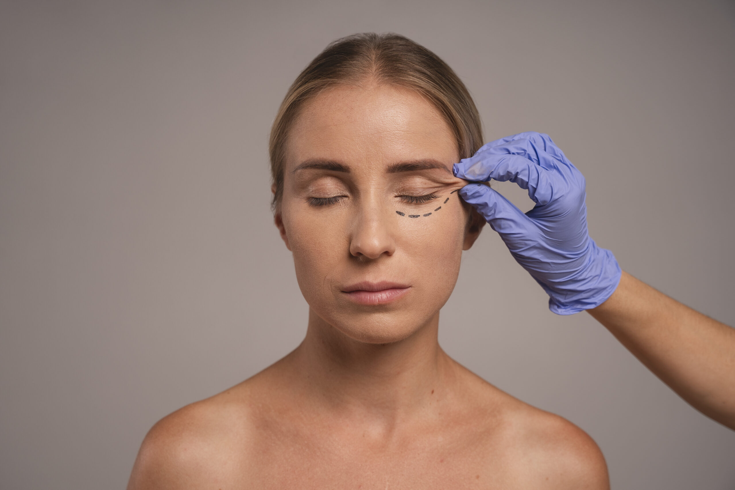 Blefaroplastia Não Cirúrgica com Jato de Plasma: como funciona, para quem é indicada e quais resultados esperar