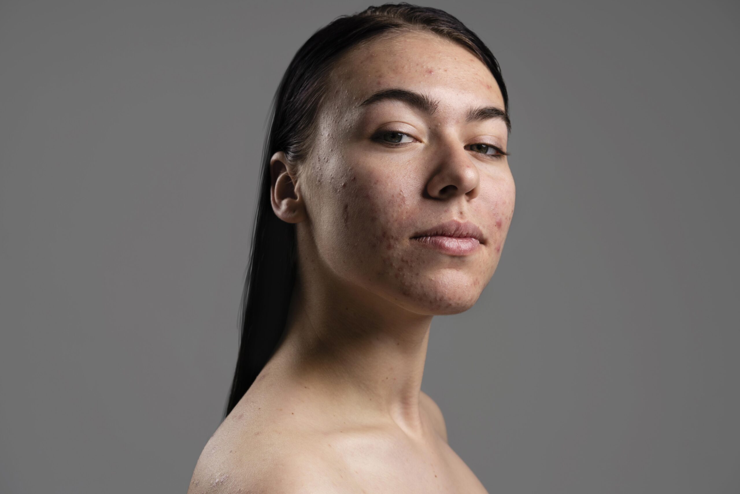 Acne: Por que acontece, como tratar e o que realmente funciona